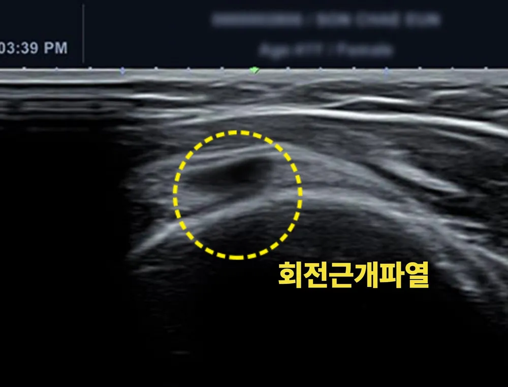 회전근개파열