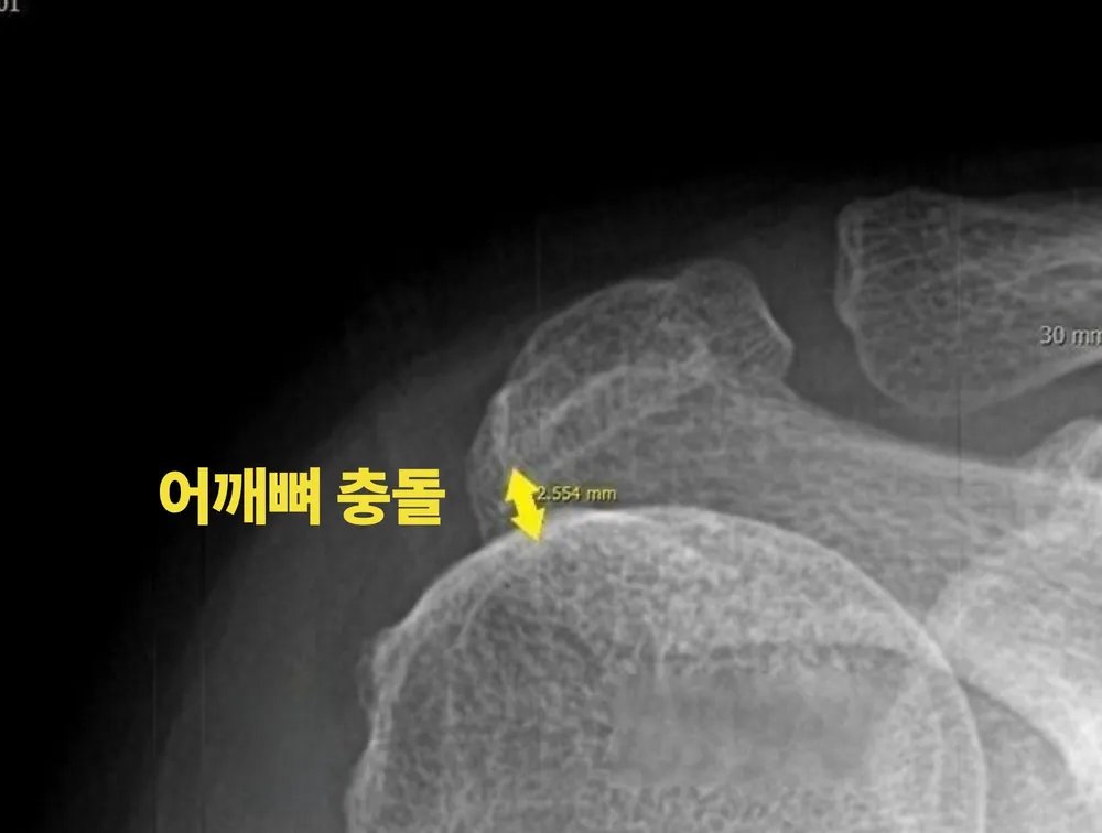 어깨충돌증후군