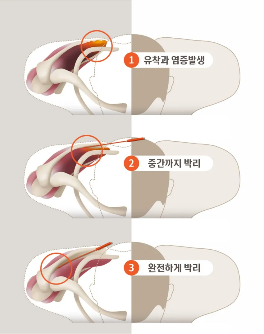 장침치료 날개뼈 박리