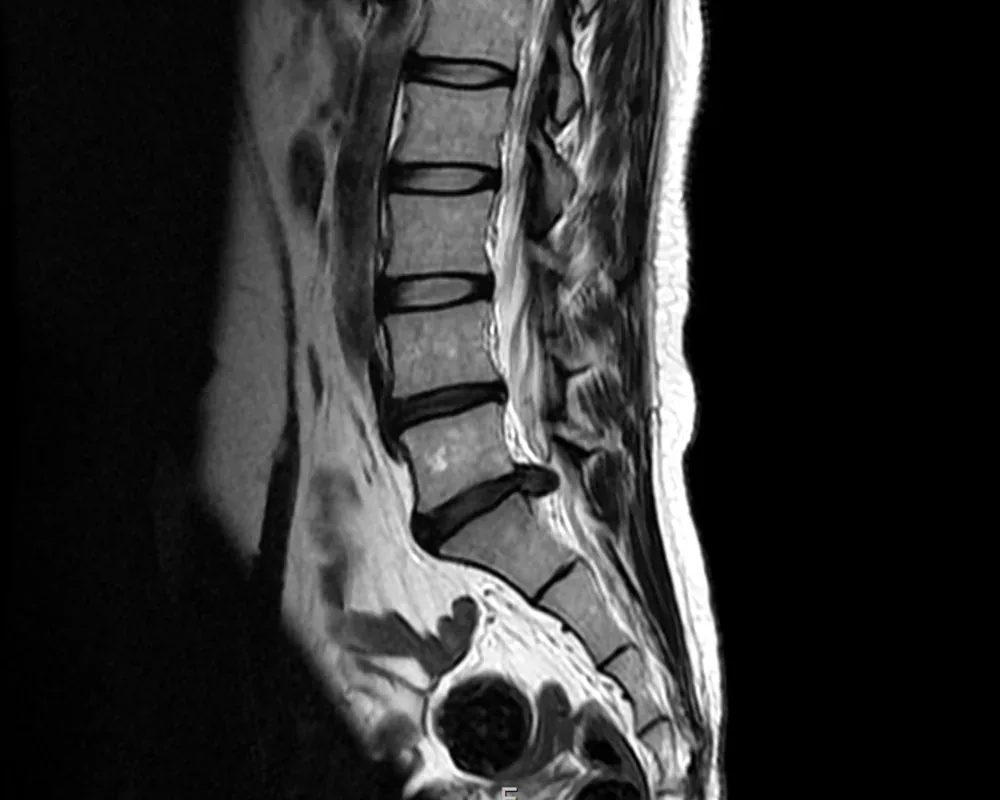 디스크 MRI 영상