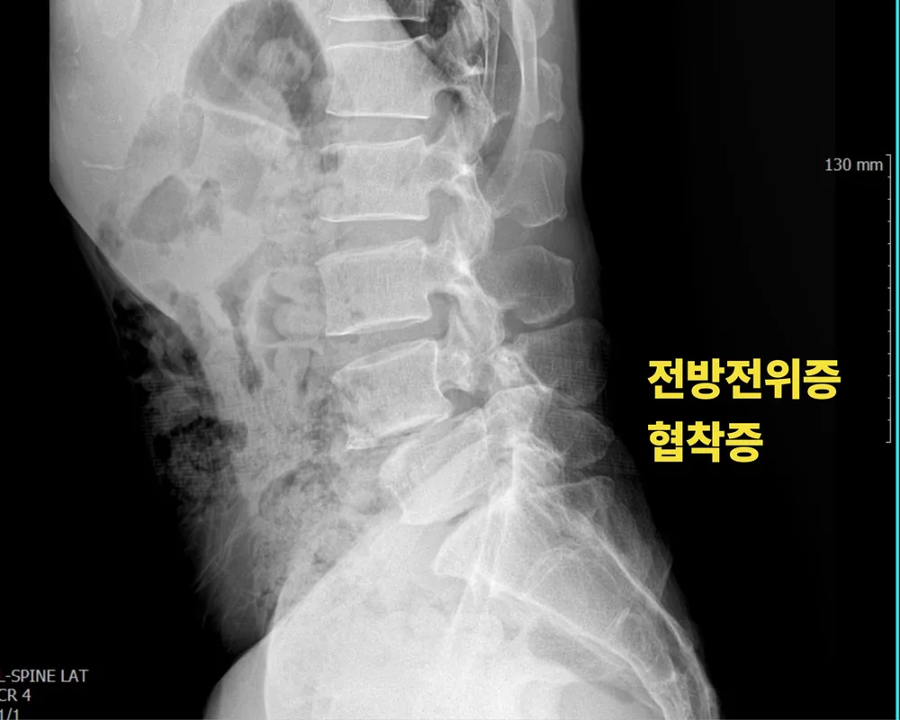 협착증 X-ray