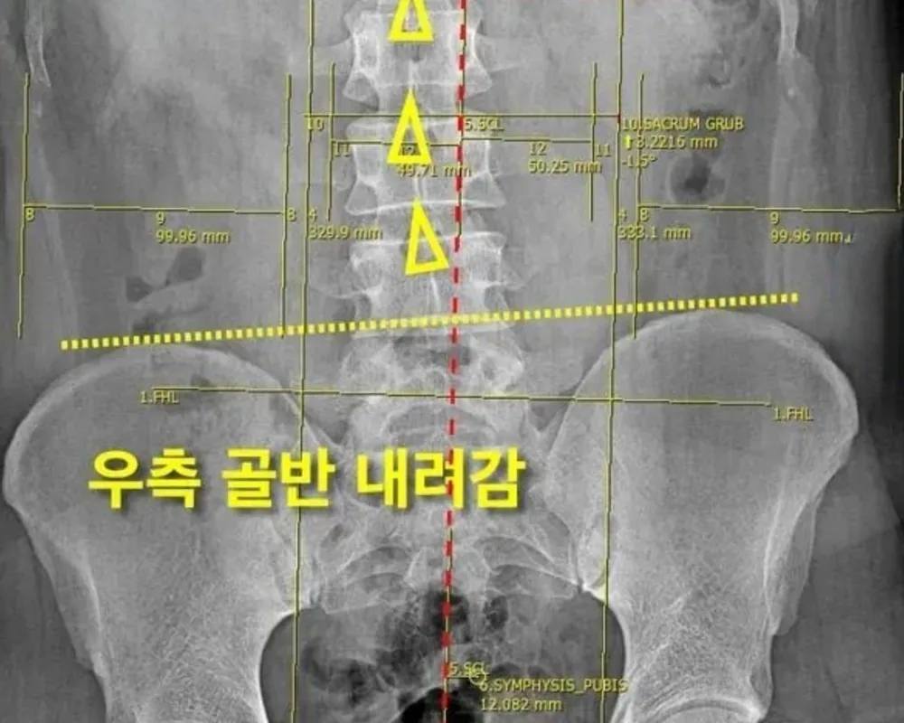 골반교정 X-ray