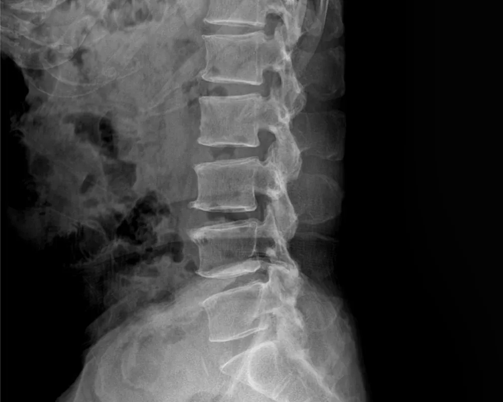 척추교정 X-ray