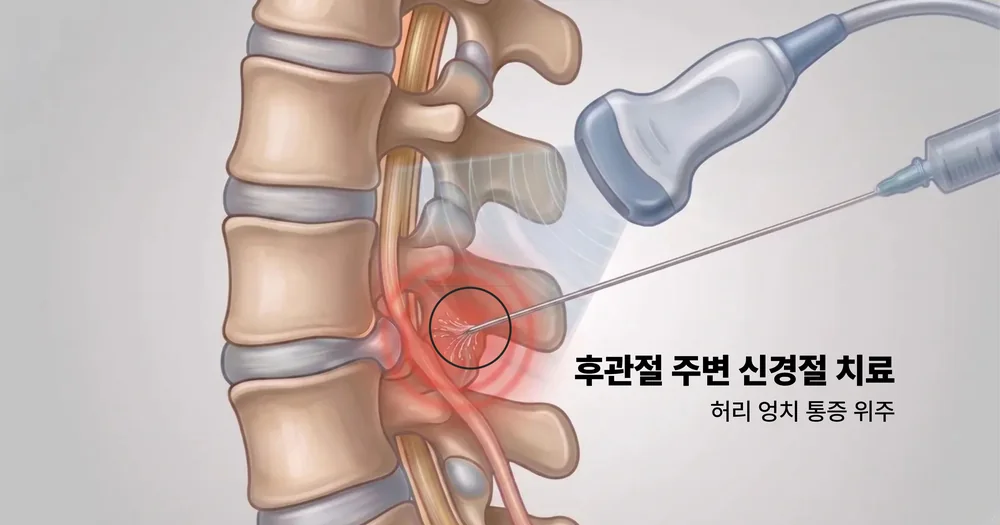 후관절 주변 신경절 약침치료 (허리·엉치 통증)